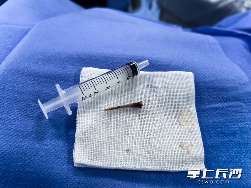 手术取出的鱼刺。
