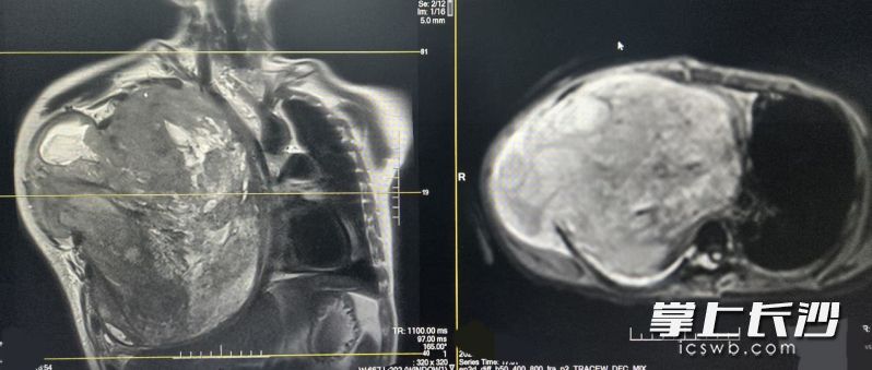 右侧胸部几乎完全被肿瘤占位。