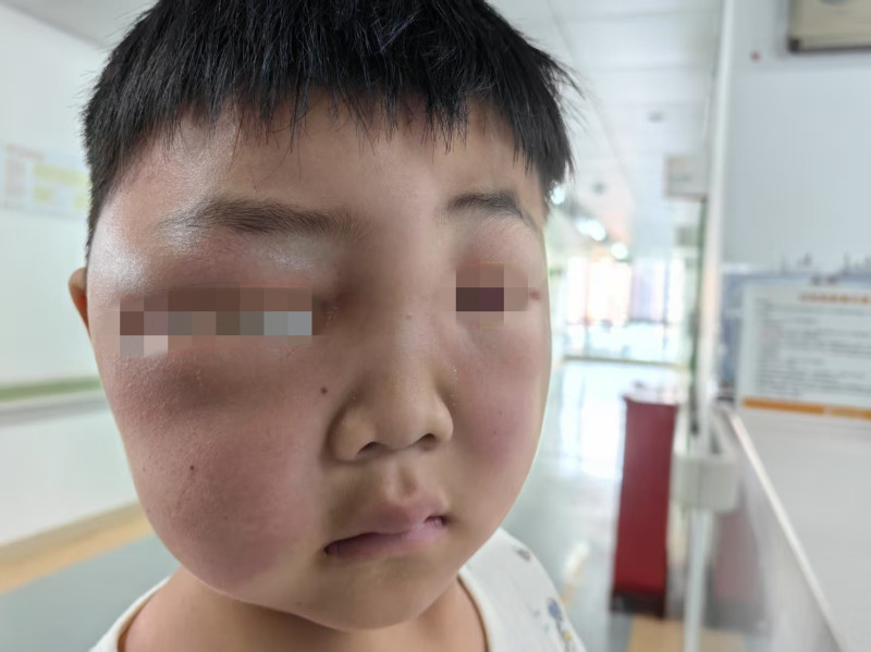 入院时，洋洋的脸又肿又疼。 医院供图
