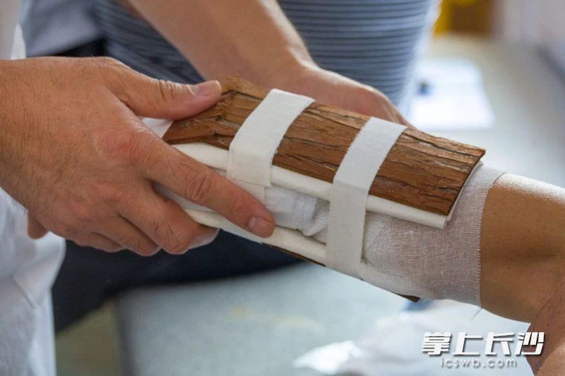 个体化小夹板固定。江氏正骨术根据患者骨折部位、局部特点、错位形式等，选用原生态的杉树皮制作成相应的小夹板，应用已获得国家专利的江氏骨药外敷，再予以加压垫及夹板固定，透气性好、价格低廉。李锋 摄