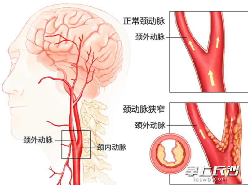 正常颈动脉与颈动脉狭窄示意图。通讯员供图