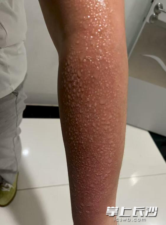 女子漂流未做防晒防护措施，造成上肢10%面积的二度晒伤。