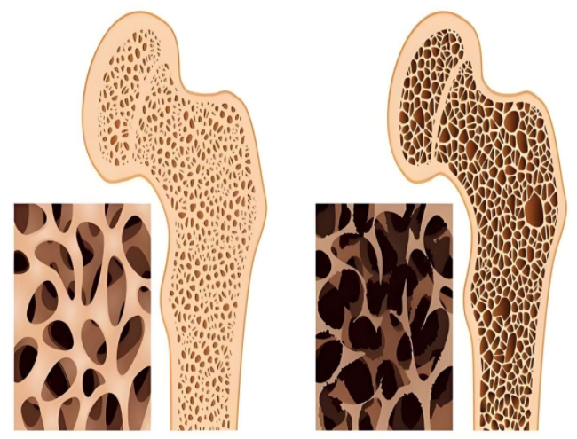 骨质疏松示意图。前图为“正常骨”,后图为“骨质疏松”。 资料图片 骨质疏松示意图。前图为“正常骨”,后图为“骨质疏松”。 资料图片