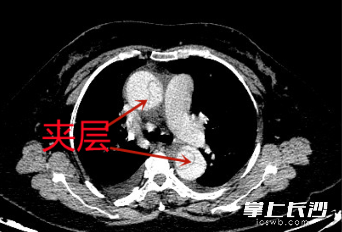 患者进行CT检查，提示其患上凶险的“主动脉A型夹层”。 通讯员供图