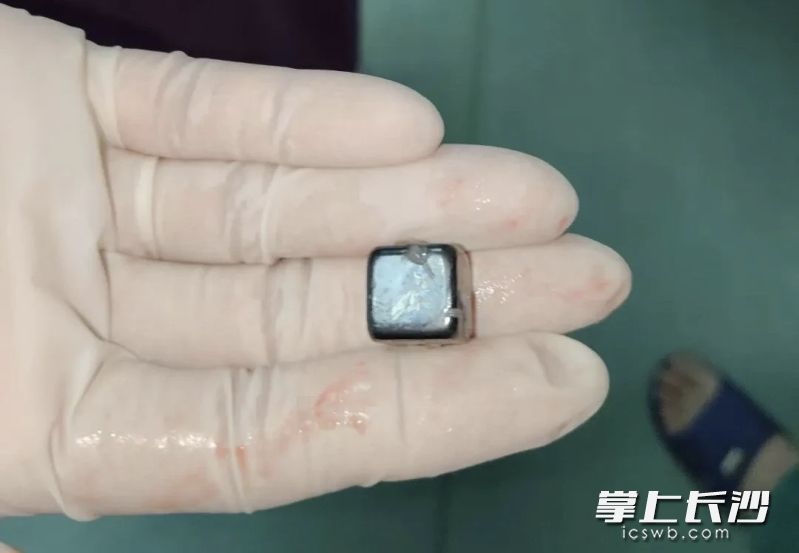 医生从患儿胃中取出的磁铁。 长沙晚报通讯员 周小艳 王颖 供图