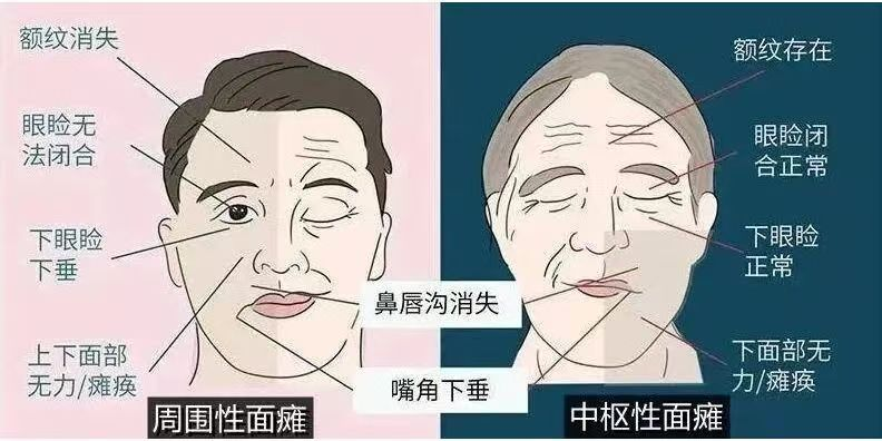 周围性面瘫和中枢性面瘫对比示意图。通讯员供图