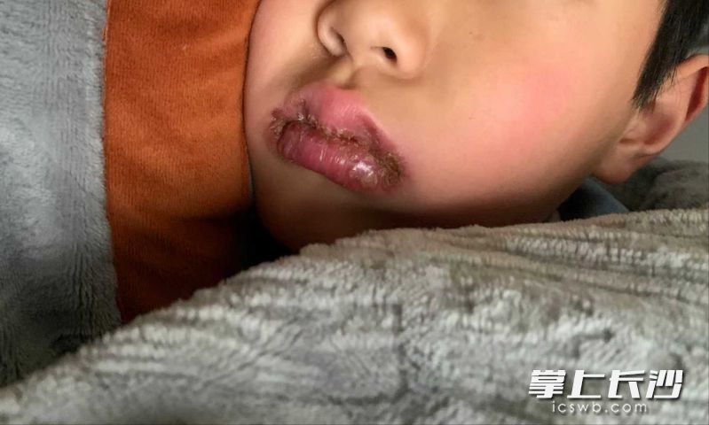 洋洋入院时难以进食。医院供图