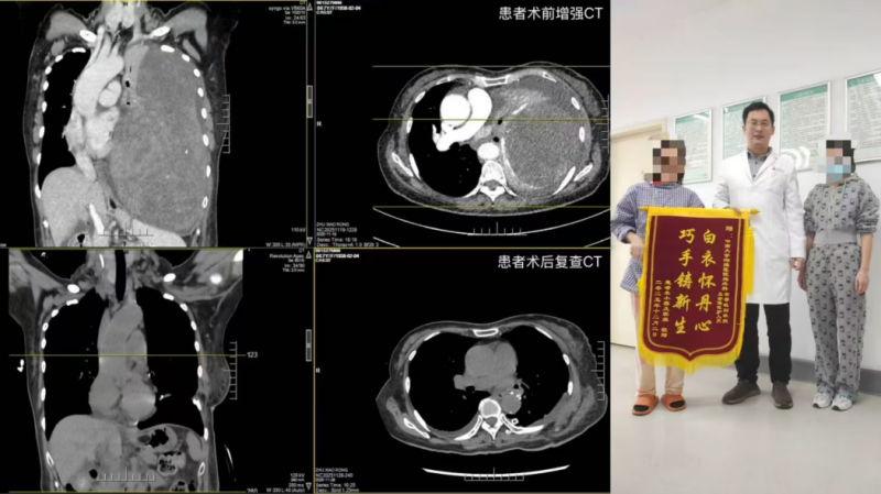 左图为患者术前术后CT对比,右图为患者及家属出院前与常睿敏副教授合影。长沙晚报通讯员 王静 摄 左图为患者术前术后CT对比,右图为患者及家属出院前与常睿敏副教授合影。长沙晚报通讯员 王静 摄
