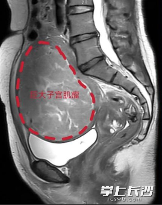 巨大子宫肌瘤示意图。  医院供图