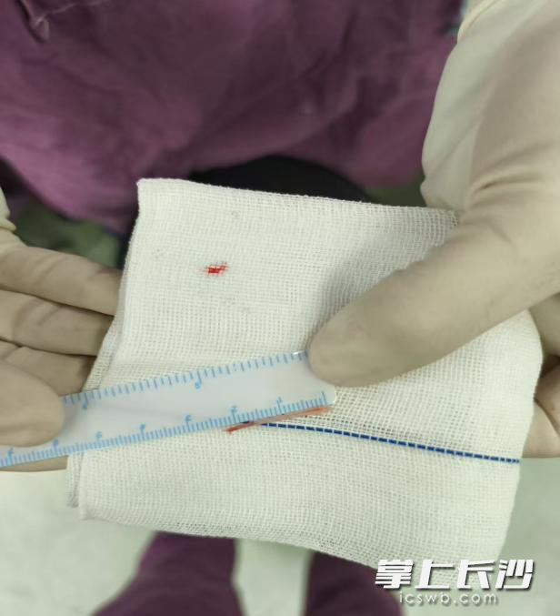 这根2.5厘米的鱼刺在患者体内“游走”5天，最终医生通过颈侧切开手术才成功取出。通讯员供图