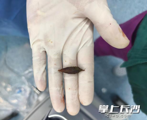 从患者体内手术取出的枣核。 从患者体内手术取出的枣核。