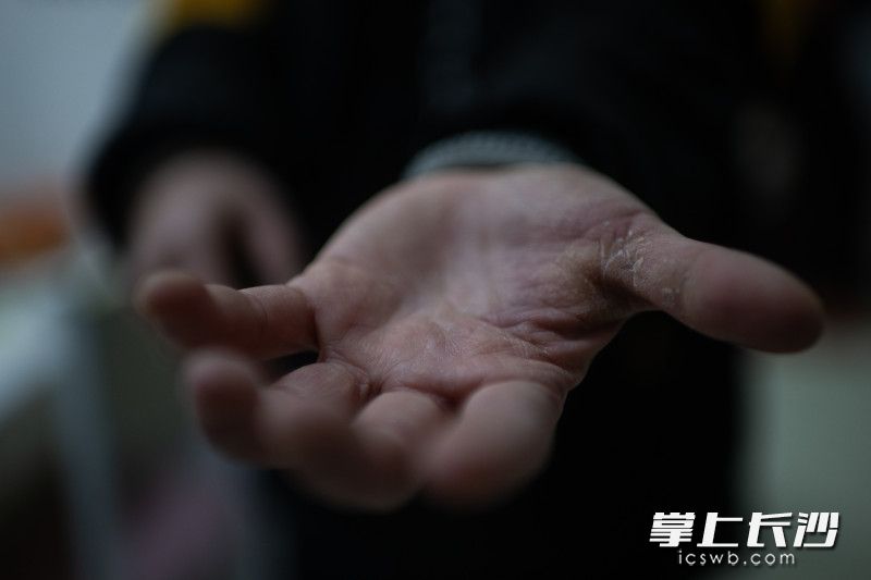 她的手上被电动车手把磨出了厚厚的茧。