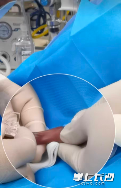 护士一次性为患儿实施直径约0.33毫米、1.0FrPICC导管置管，建立起营养与药物的长期生命支持通路。