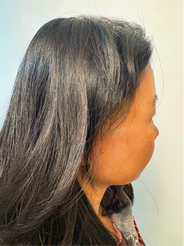 患者术后面部和颈部几乎看不到明显手术痕迹