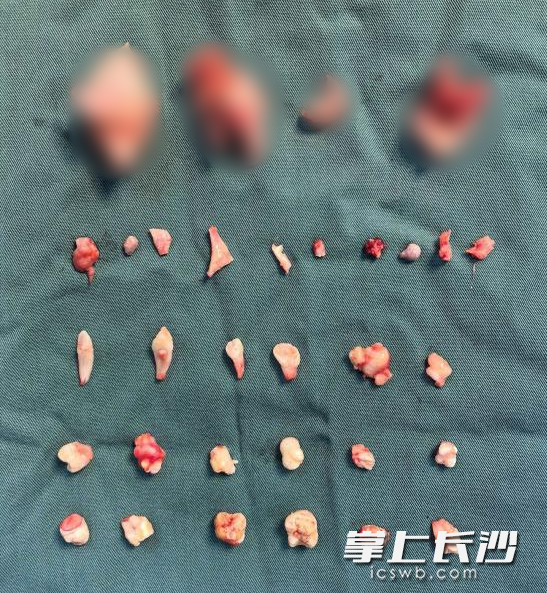 术中清理出来的肿瘤内容物包含牙齿、骨骼等。