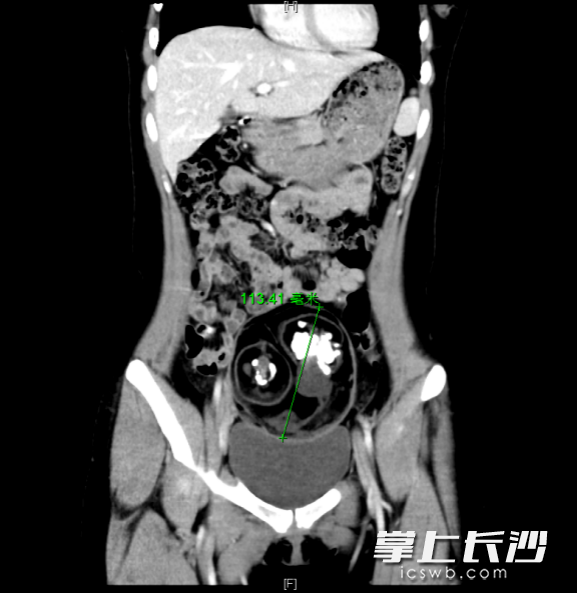 CT检查显示，患者下腹部有一直径约12厘米的肿块。均为通讯员供图