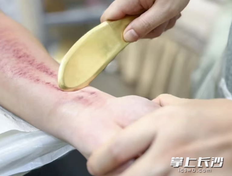 专家认为刮痧不必刻意追求出痧，以皮肤微微泛红、有少量痧点为宜。 通讯员供图