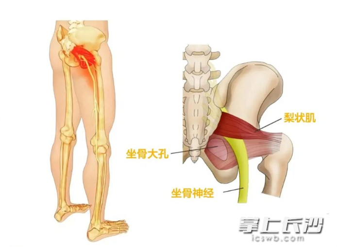 梨状肌综合征往往是由于坐骨神经在臀部受到卡压所引起。