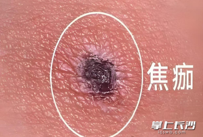 恙虫病“小黑痂”示意图。