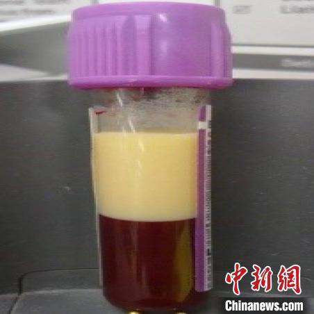 有一半是“油脂”一样的液体。广医三院 供图