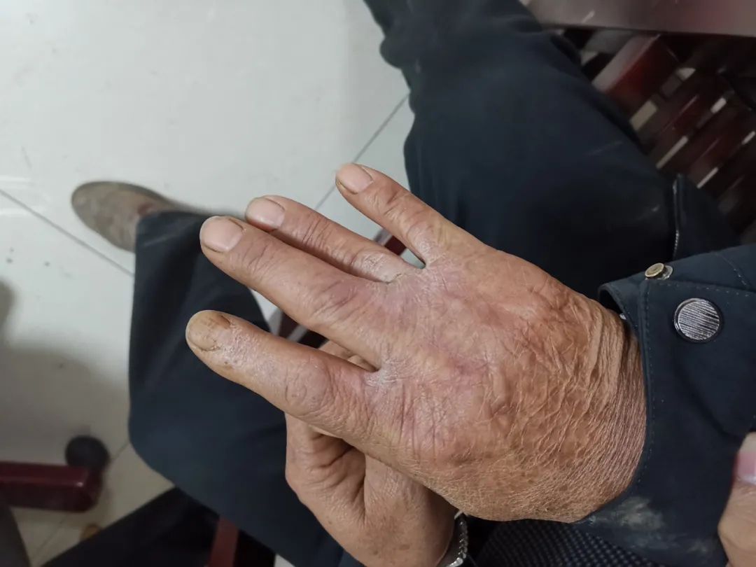 这是文某强在案发前留下的，一次意外的火灾让他右手严重烧伤