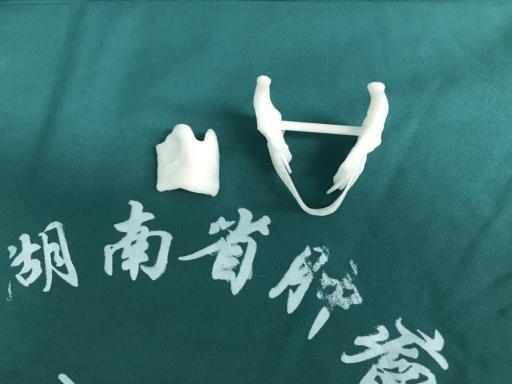 数字化3D打印技术辅助喉癌手术。医院供图