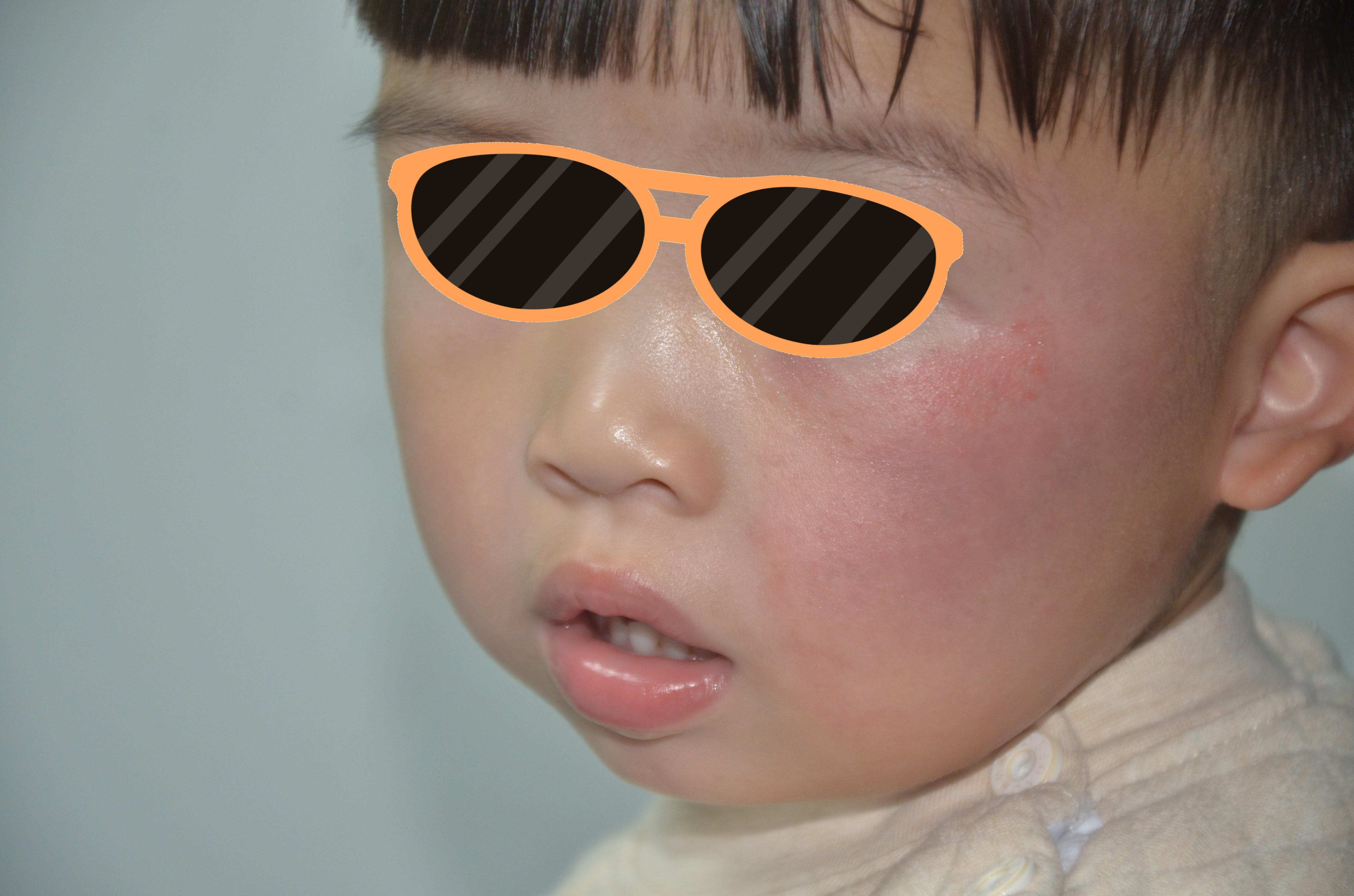 天天太田痣2次皮秒治疗前后