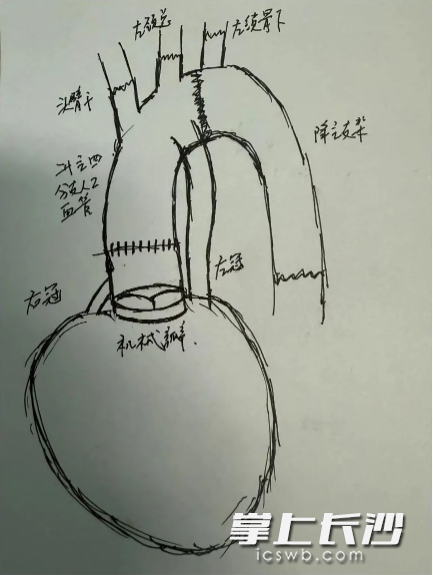 血管外科主任、主任医师李可手绘手术方案。