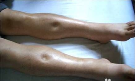 高度水肿的下肢。