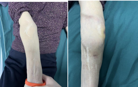 患者双上肢因动静脉外瘘、自体瘘留下的手术疤痕。
患者双上肢因动静脉外瘘、自体瘘留下的手术疤痕。